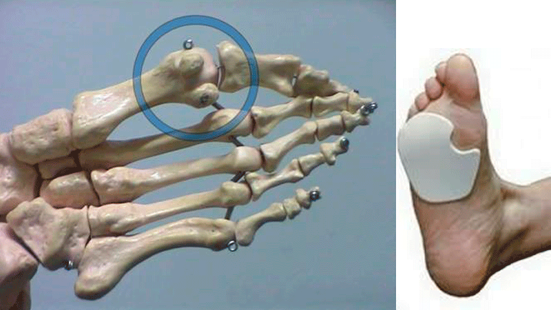 Podología-sesamoiditis, fractura de los sesamoideos y descarga de los sesamoideos