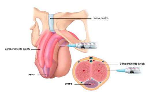 Disfunción-Eréctil,-problemas-de-ereccion Causas y Tratamiento