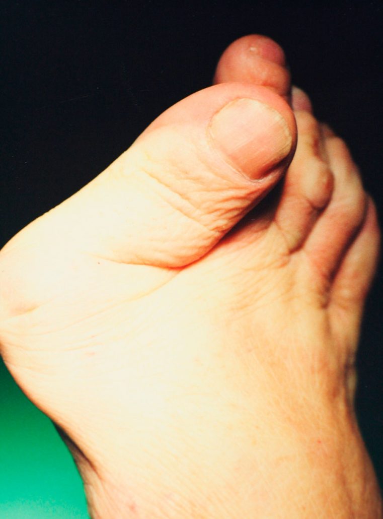 podologia mª del mar ruiz Hallux-Valgus-o-Juanete