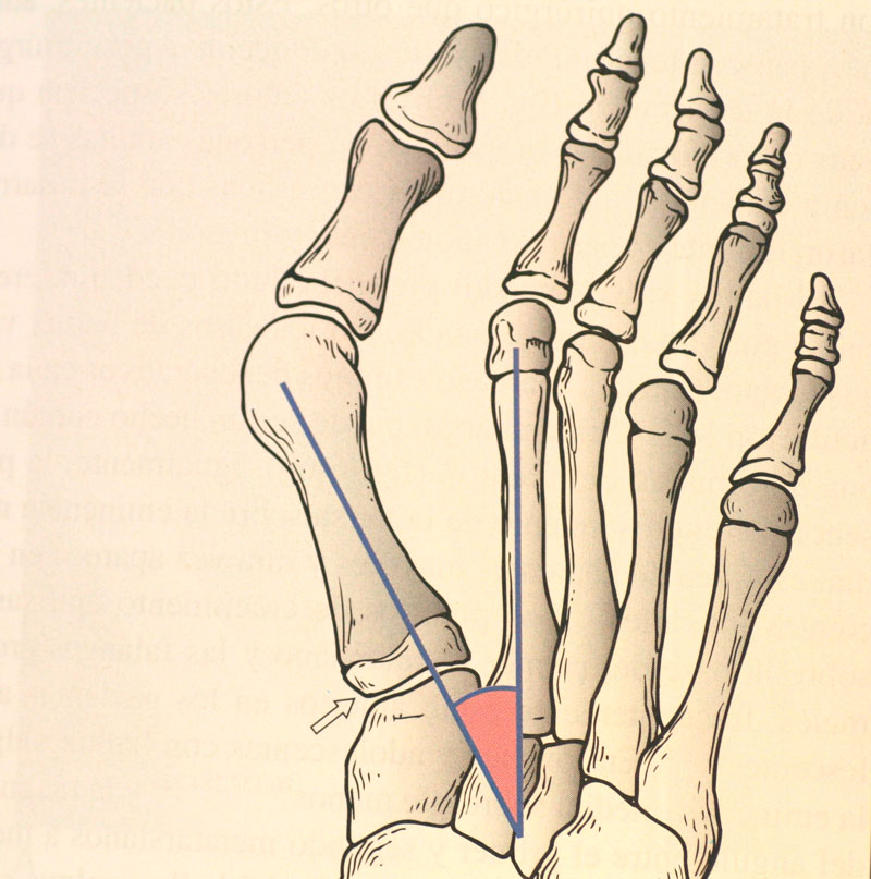 podologia mª del mar ruiz Hallux-Valgus-o-Juanete