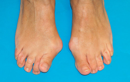 Hallux-Valgus-o-Juanete sintomas y causas