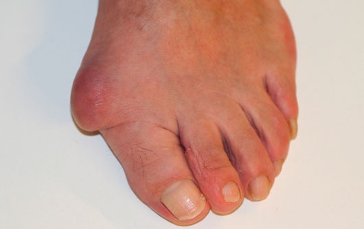 Hallux-Valgus-o-Juanete sintomas y causas