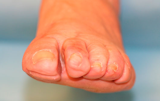 Tratamiento Quirurgico hallux valgus o juanete