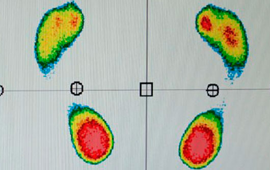 Protocolo-Estudio-Biomecánico-de-la-Pisada-3 Dismetrias Protocolo-Estudio-Biomecánico-de-la-Pisada