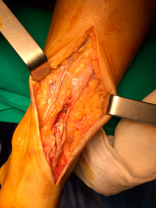 Degeneracion-y-rotura-del-tendon-de-aquiles