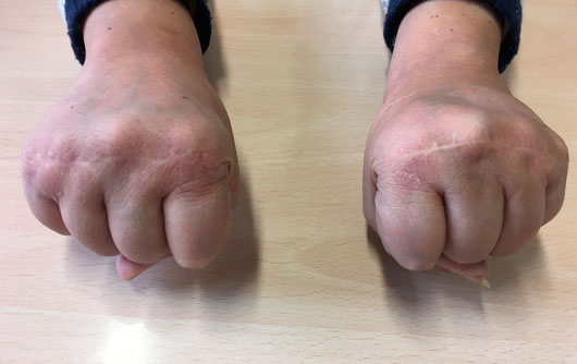 Lupus--Eritematoso-cirugía-de-la-mano-y-traumatologia-2 Puños cerrados Lupus--Eritematoso-cirugía-de-la-mano-y-traumatologia