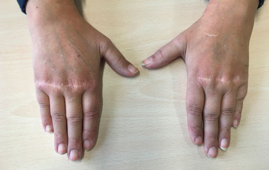 Lupus--Eritematoso-cirugía-de-la-mano-y-traumatologia Manos extendidas Lupus--Eritematoso-cirugía-de-la-mano-y-traumatologia