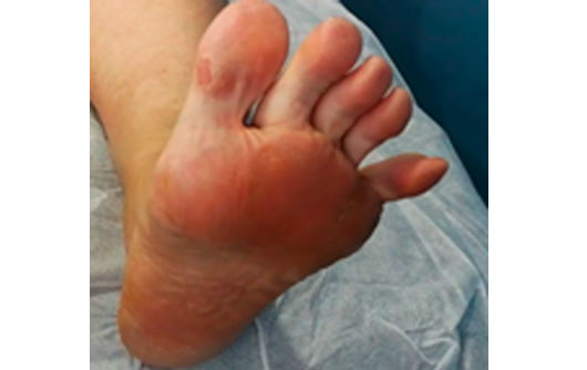 Podologia y Neuropatía Compresiva de Baxter