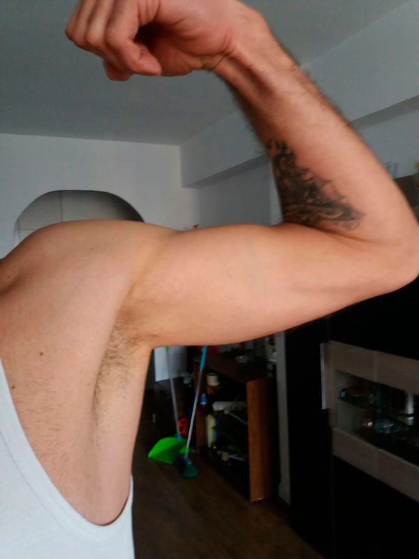 Resultado-de-la-reparación-de-la-Rotura-biceps-distal Resultado-de-la-reparación-de-la-Rotura-biceps-distal Traumatologia y Cirugia de Miembro superior