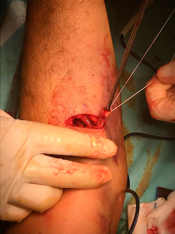 Rotura-biceps-distal-cirugia-miembro-superior Rotura-biceps-distal Traumatologia y Cirugia de Miembro superior
