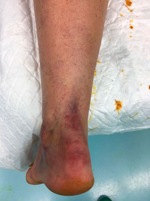 Rotura-del-tendon-de-aquiles Traumatologia