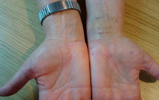 Sindrome-del-Túnel-del-Carpo-1 Traumatología y Sindrome-del-Túnel-del-Carpo