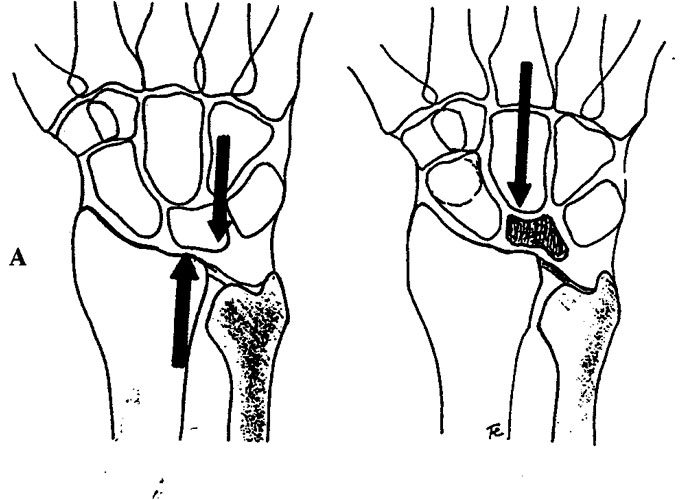Enfermedad de Kienbock 1
