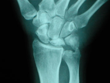 Enfermedad de Kienbock 4