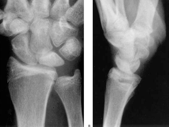 Enfermedad de Kienbock 7