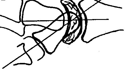 Enfermedad de Kienbock 9